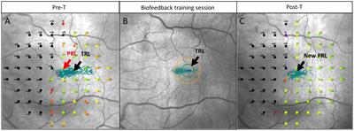 Innovative vision rehabilitation method for hemianopsia: Comparing pre- and post audio-luminous biofeedback training for ocular motility improving visual functions and quality of life